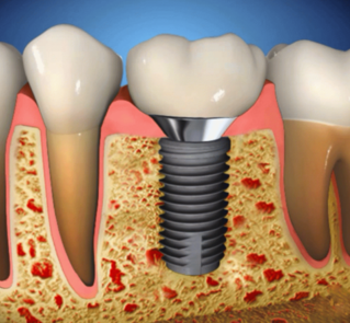 Имплантация зубов.