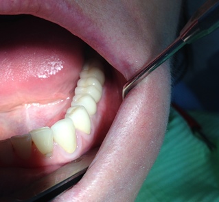 Зубы на имплантах жевательной группы